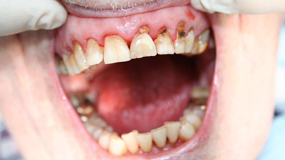 Desolate dentitie als gevolg van wortelcariës