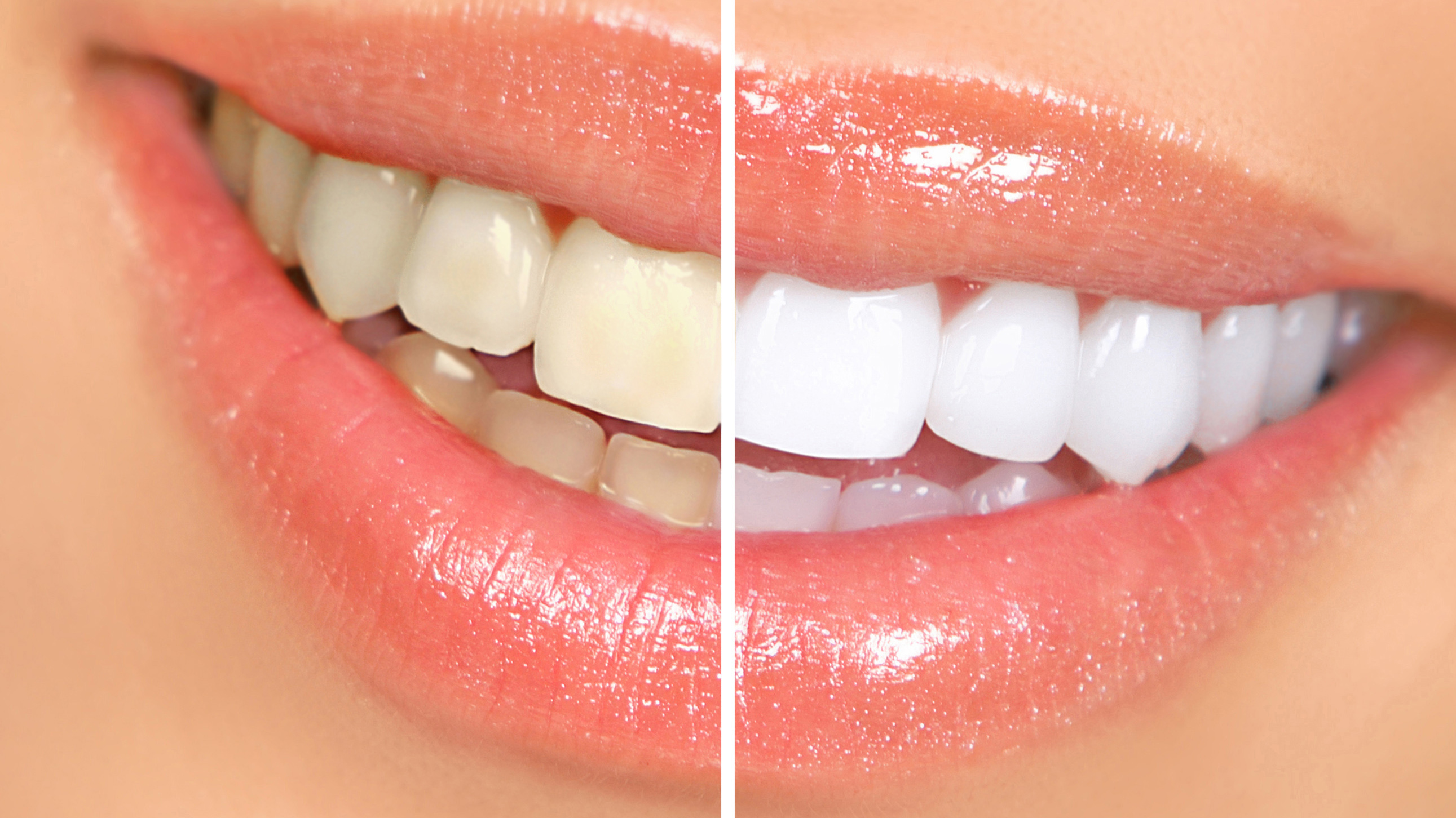 Wat kun je van whitening tandpasta verwachten?