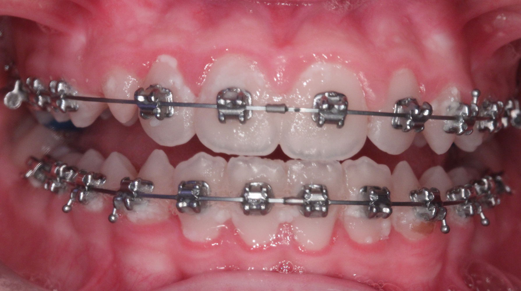 Preventie van wittevleklaesies die ontstaan tijdens een behandeling met vaste orthodontische apparatuur