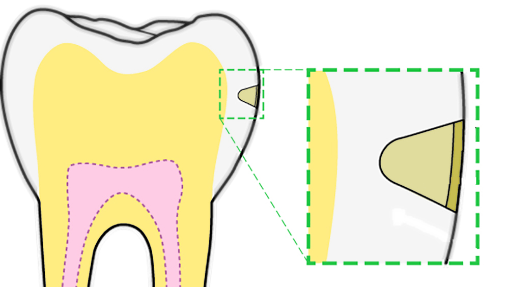 Behandeling van postorthodontische wittevleklaesies