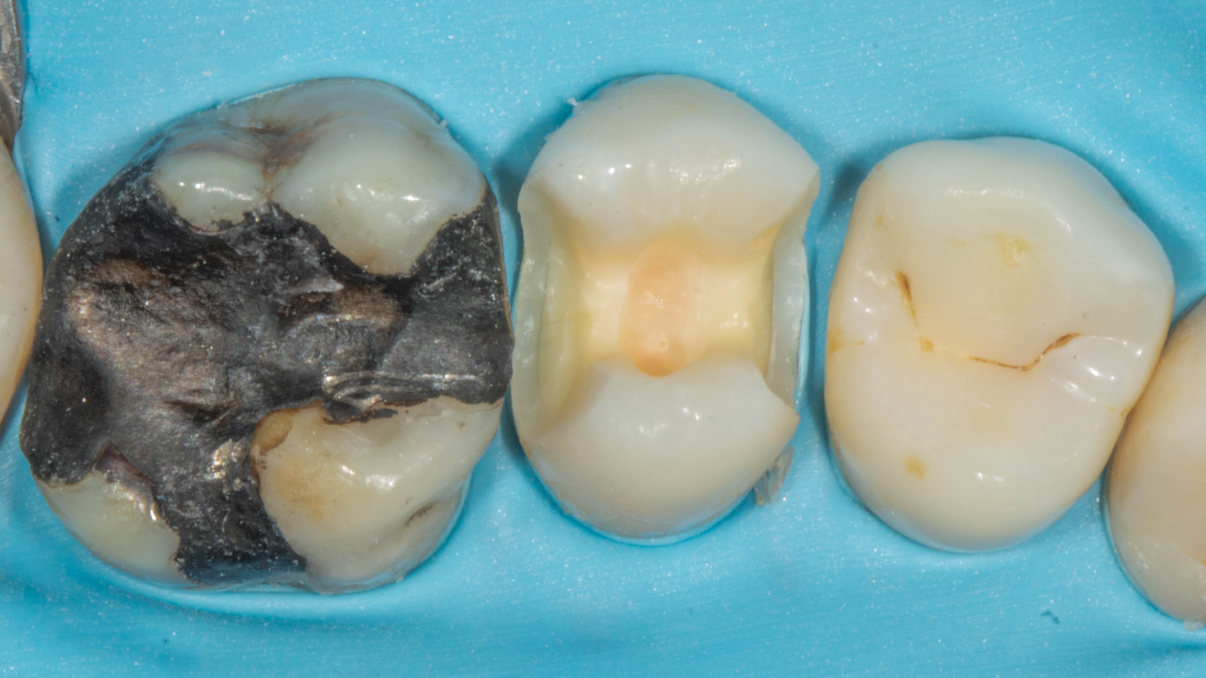 Restauratieve keuzes voor endodontisch behandelde gebitselementen in de posterieure zone