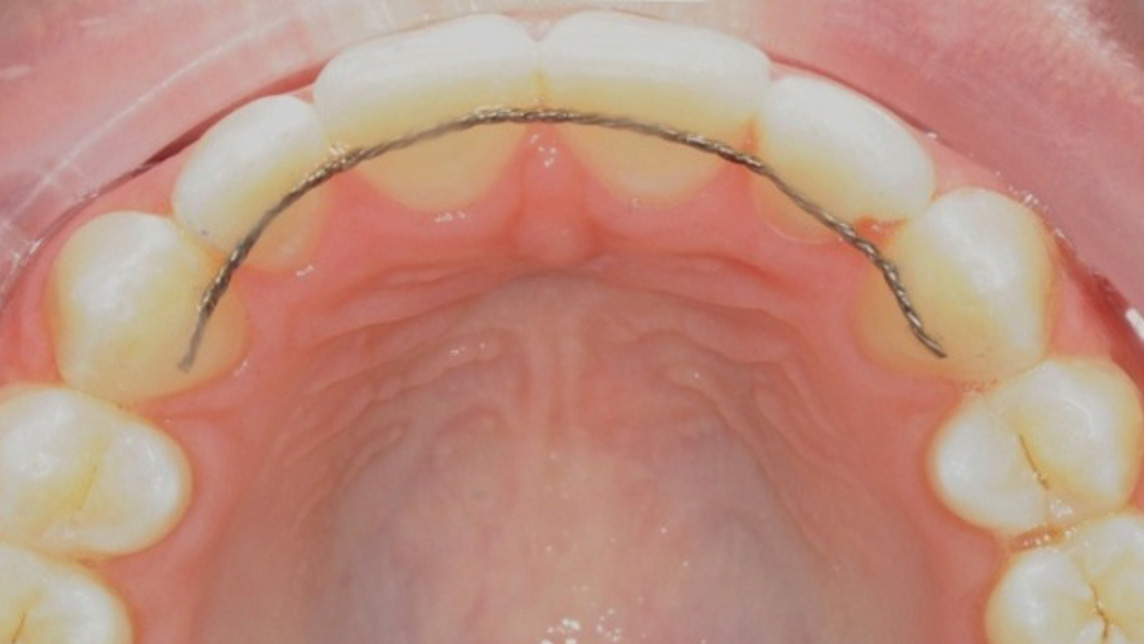 Retentie na de orthodontische behandeling