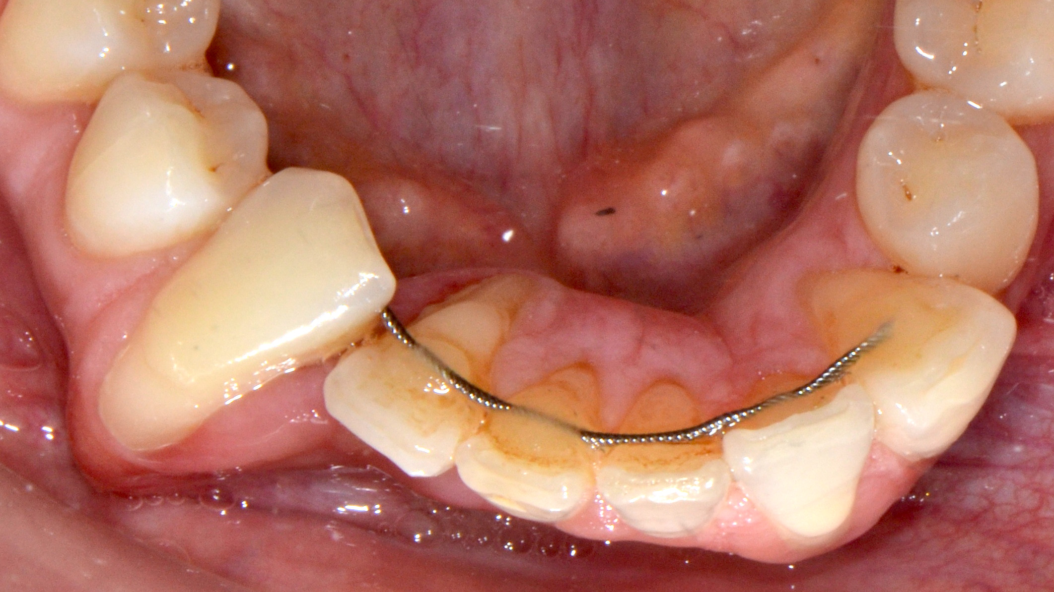 Orthodontische retentie: problemen en oplossingen