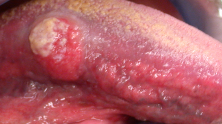 Gepersonaliseerde nacontrole bij patiënten die curatief zijn behandeld voor een plaveiselcelcarcinoom in de mondholte