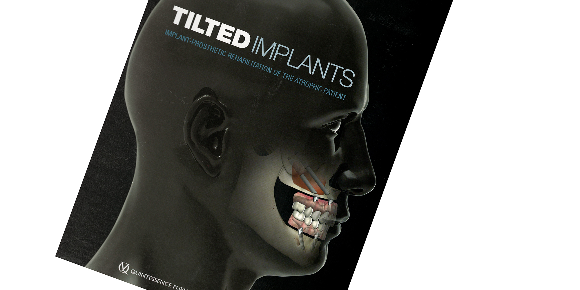 Gekantelde implantaten: stapsgewijze behandelconcepten