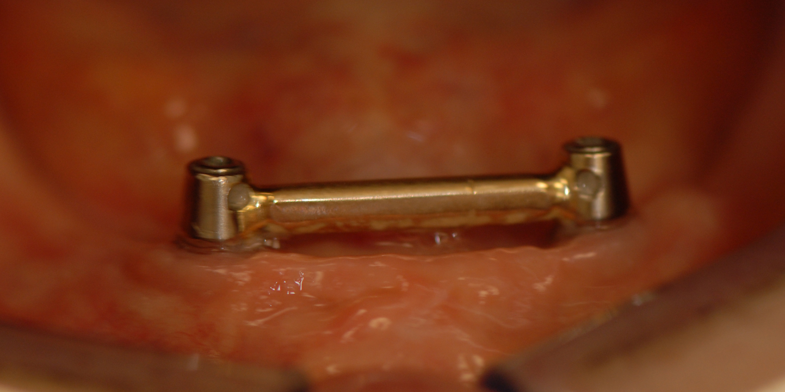 Gezondheidsaspecten van patiënten die een overkappingsprothese op implantaten ontvangen: een cross-sectioneel onderzoek