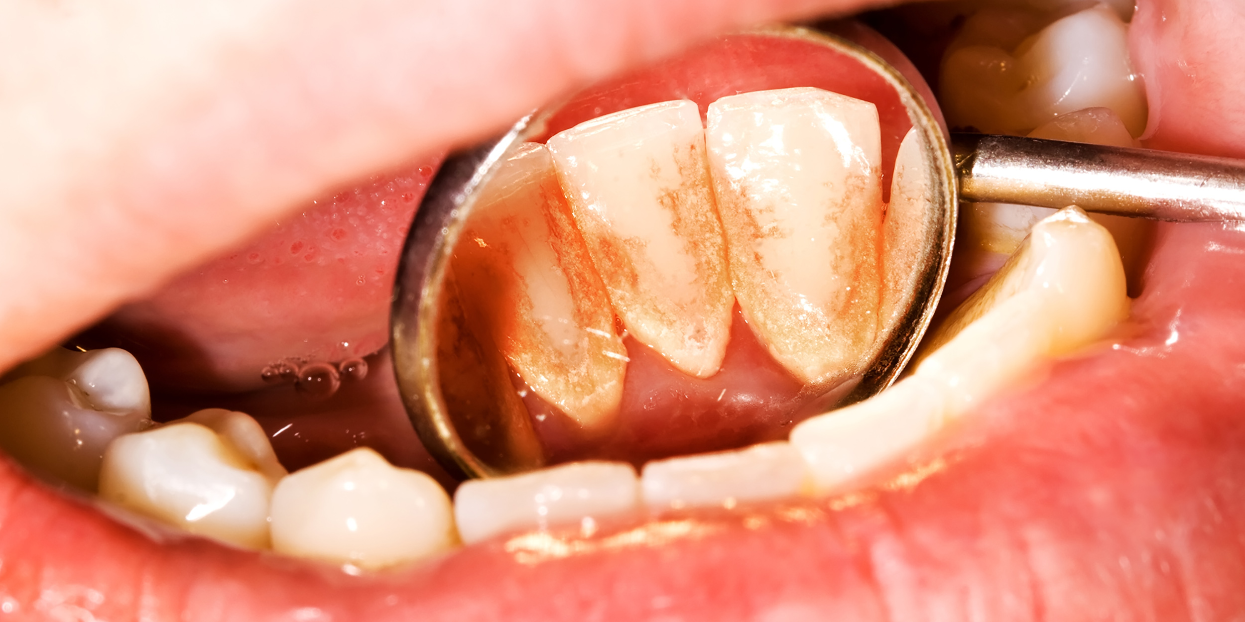 Heeft voeding invloed op de vorming van tandsteen?