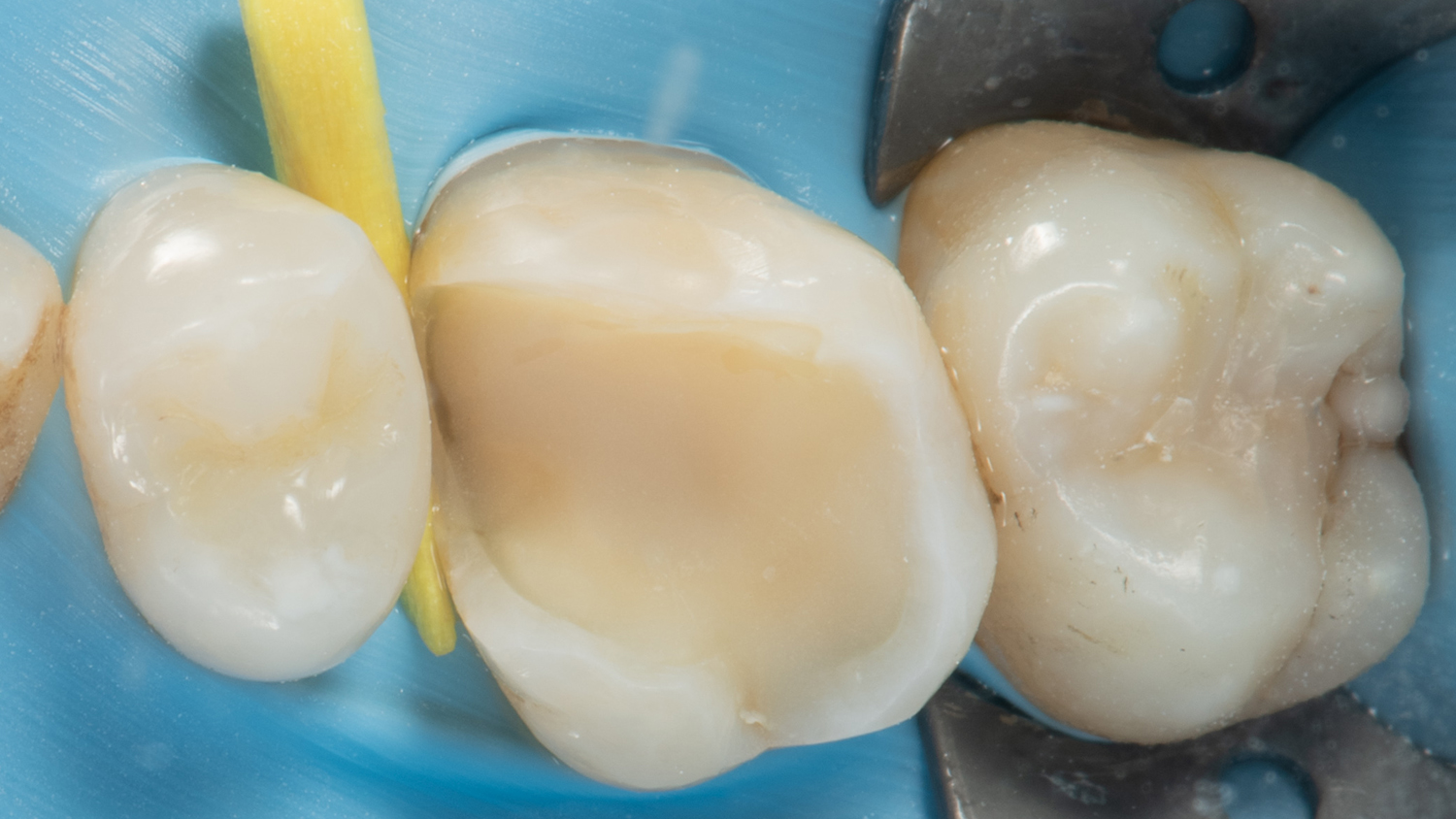 Is Immediate Dentin Sealing van meerwaarde bij partieel indirect restaureren?