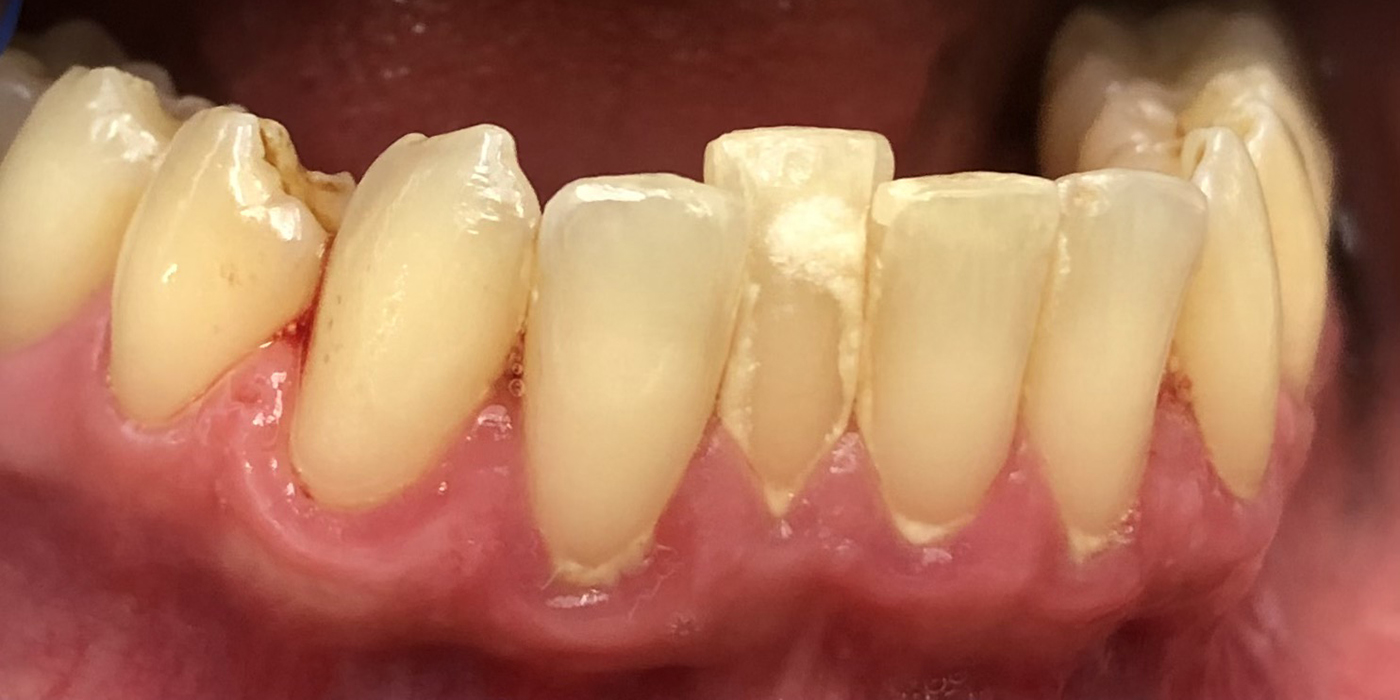 Het verwijderen van tandsteen als hoeksteen van de parodontale behandeling
