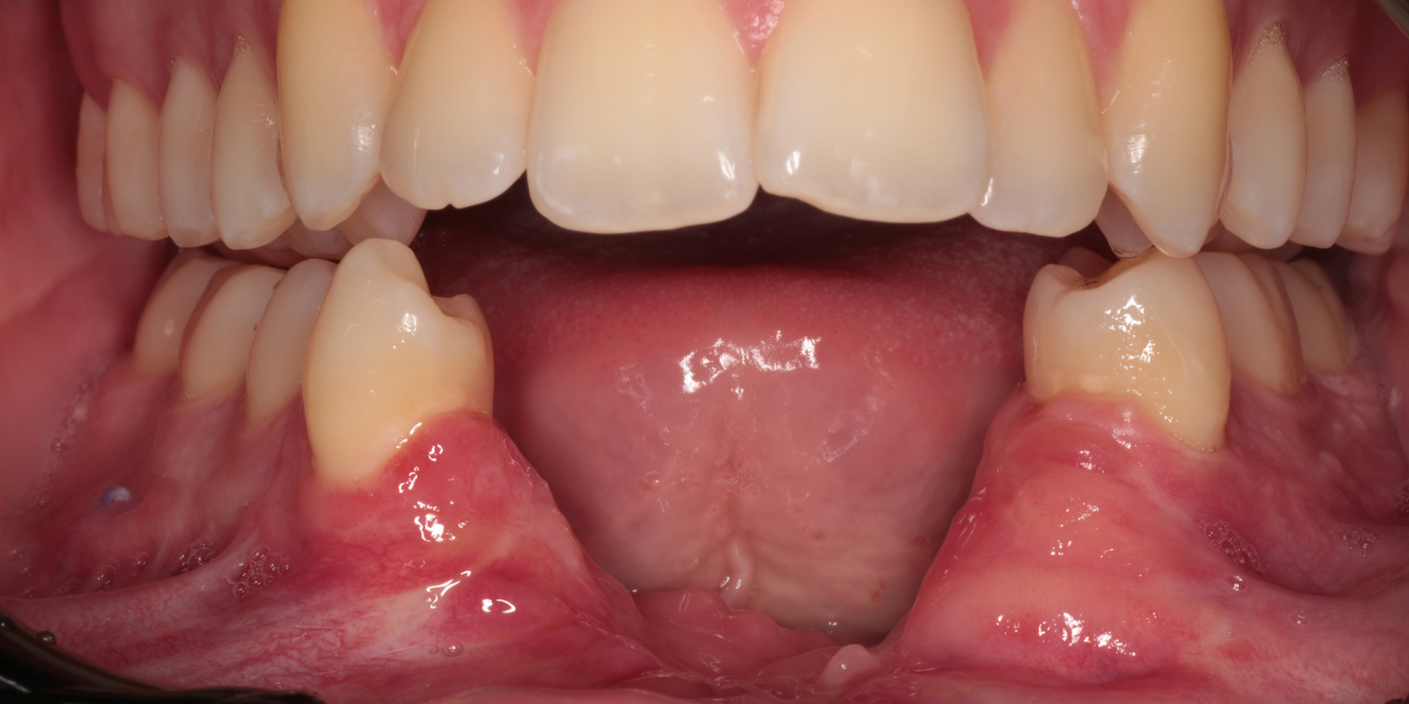 Reconstructie van de mandibula na verlies van het middensegment door een odontogeen myxoom