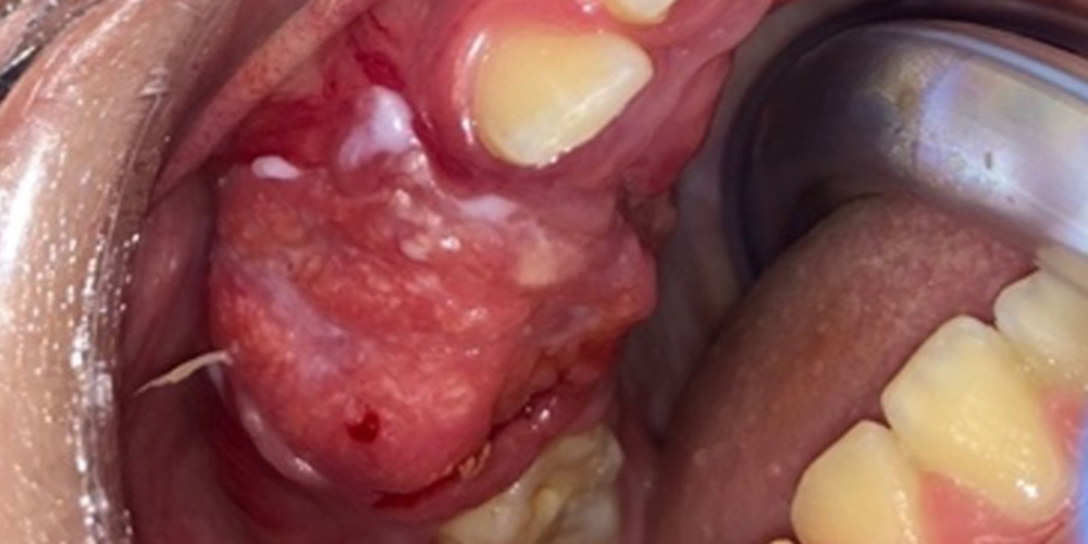 Plaveiselcelcarcinoom in mondholte komt ook voor bij kinderen
