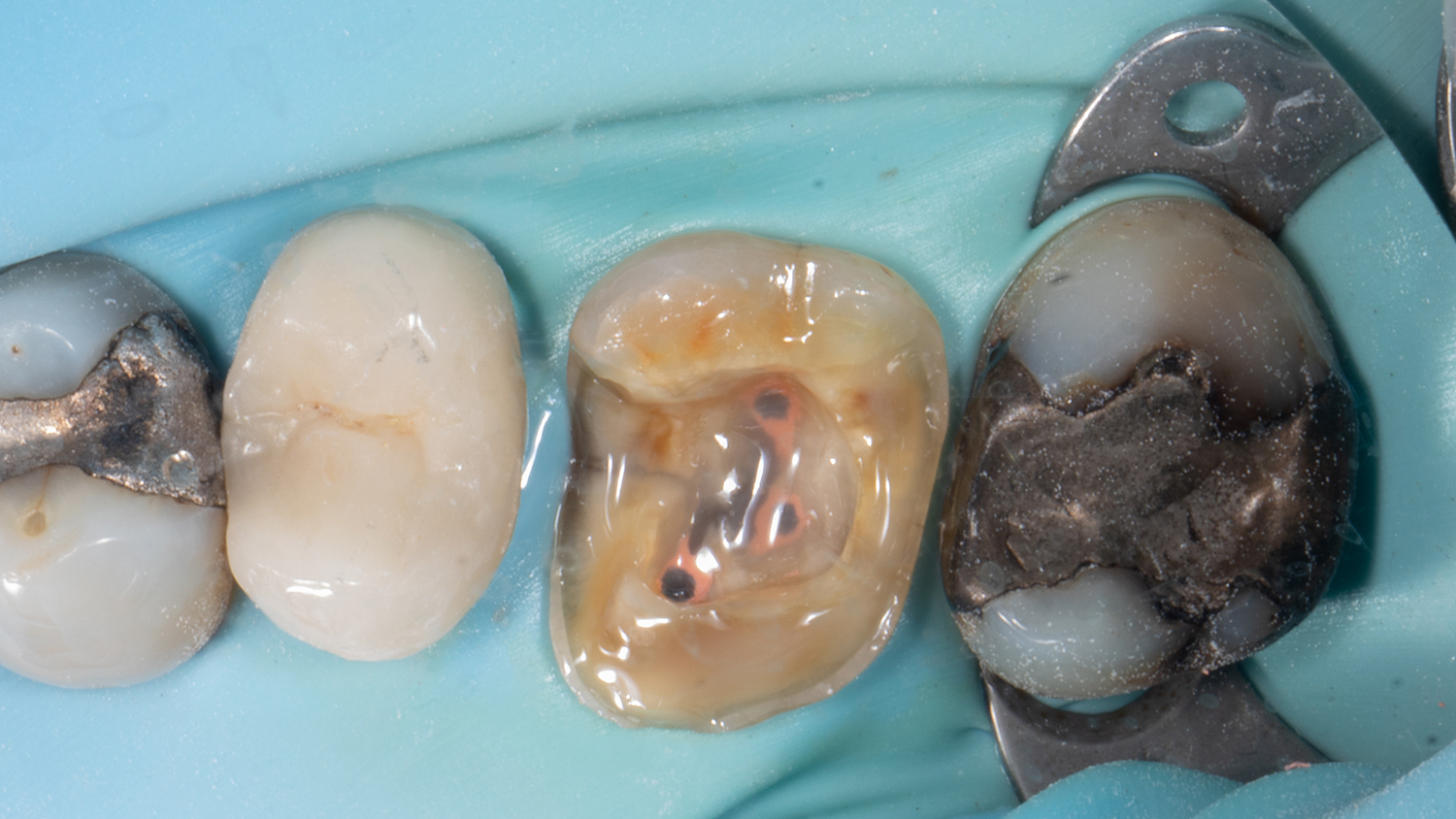 Adhesieve hechting aan het endodontisch behandelde gebitselement