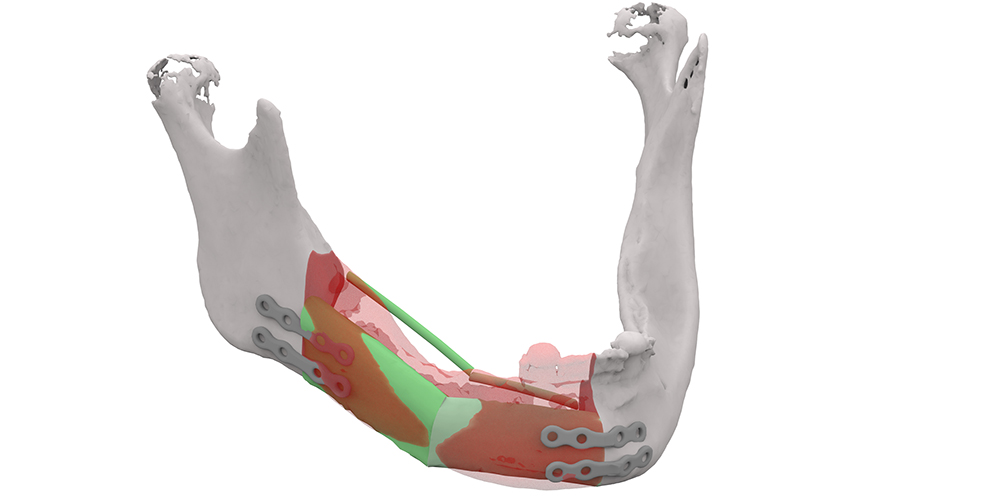 Serie: Innovatieve technieken en ontwikkelingen in de mondzorg. 3D-planning in de mka-chirurgie
