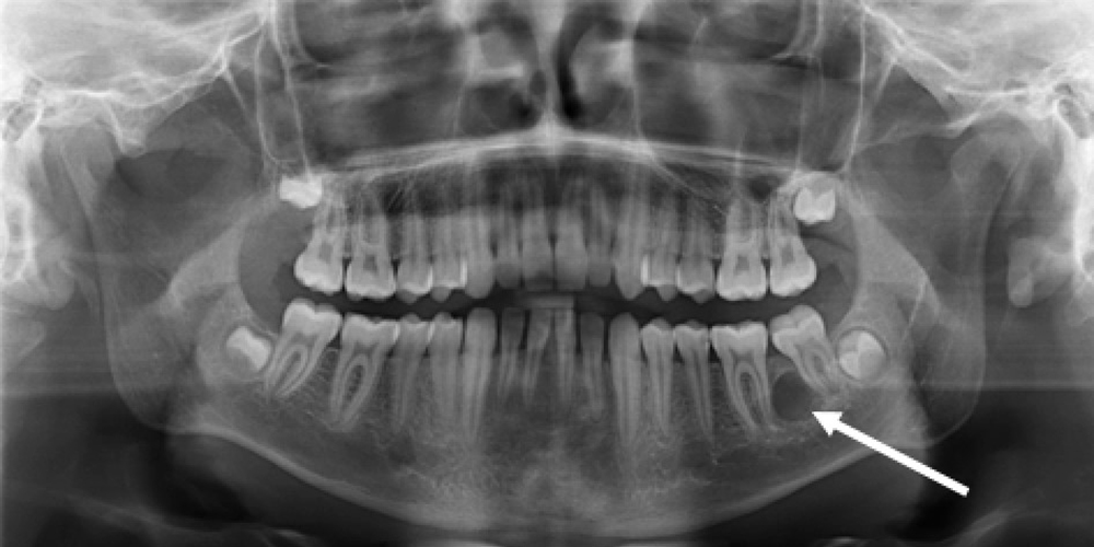 Het basaalcelnaevussyndroom: raakvlak tussen tandheelkunde en dermatologie