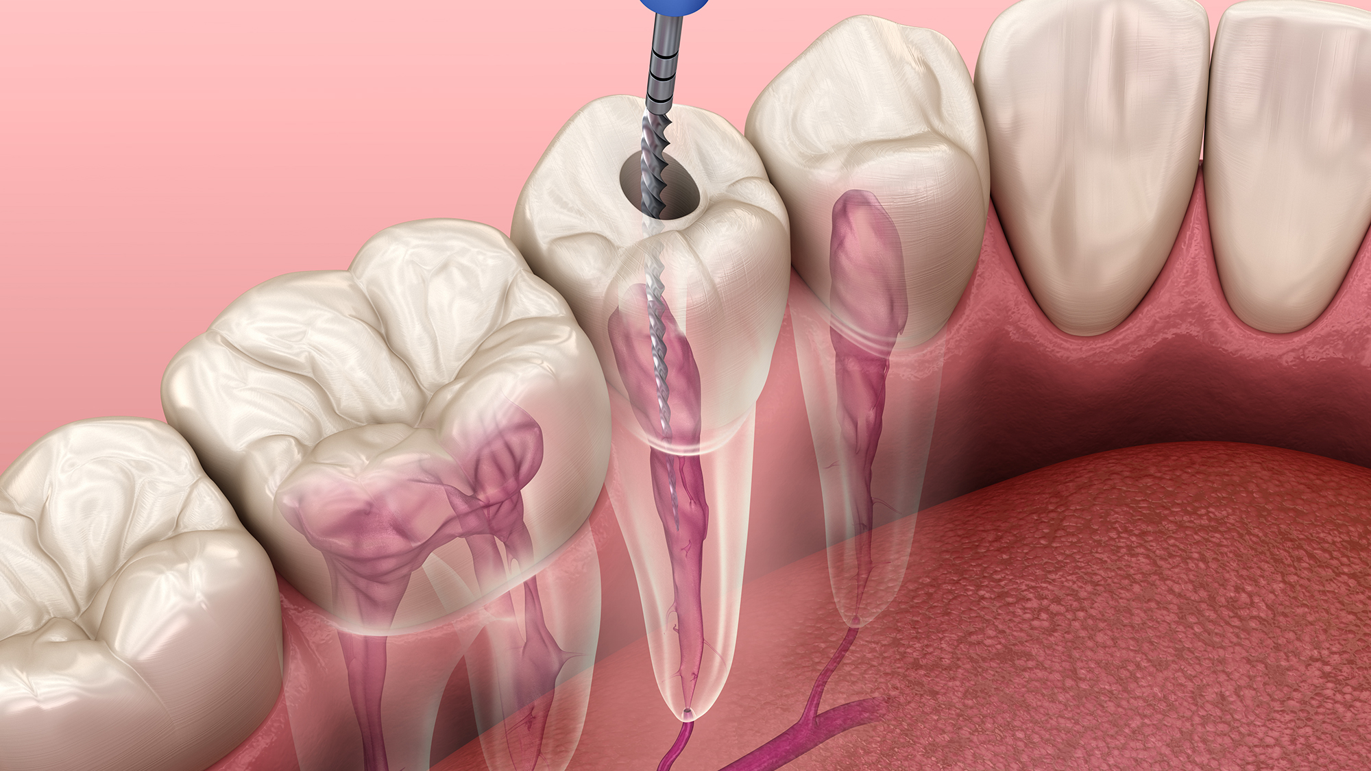 De beoordeling van het endodontische fundament