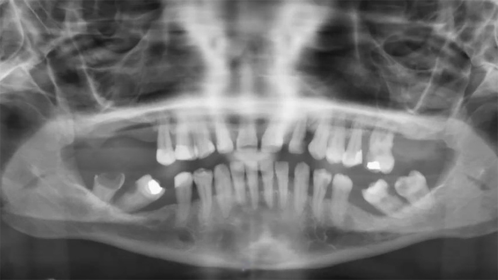 Dentale rehabilitatie bij jonge patiënt met glycogeenstapelingsziekte type 1B