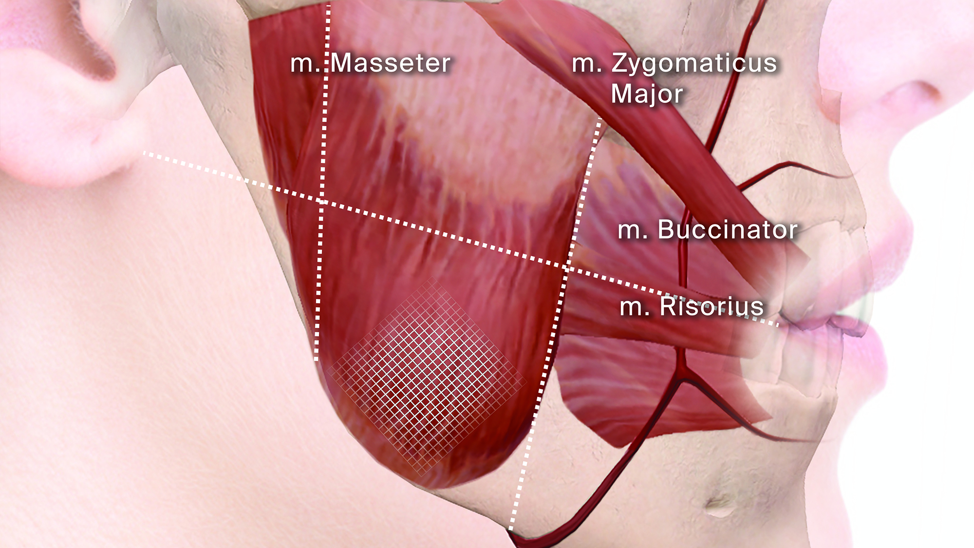 Behandeling van bruxismegeïnduceerde masseterhypertrofie, tendomyalgie en attritie met botulinetoxine