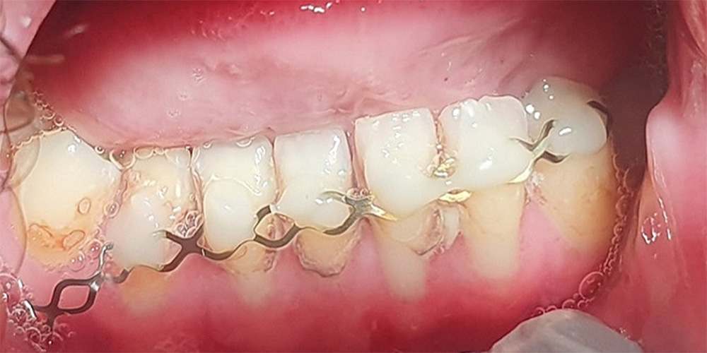 Een uitdagende tandheelkundige behandeling van een patiënt met spinale musculaire atrofie