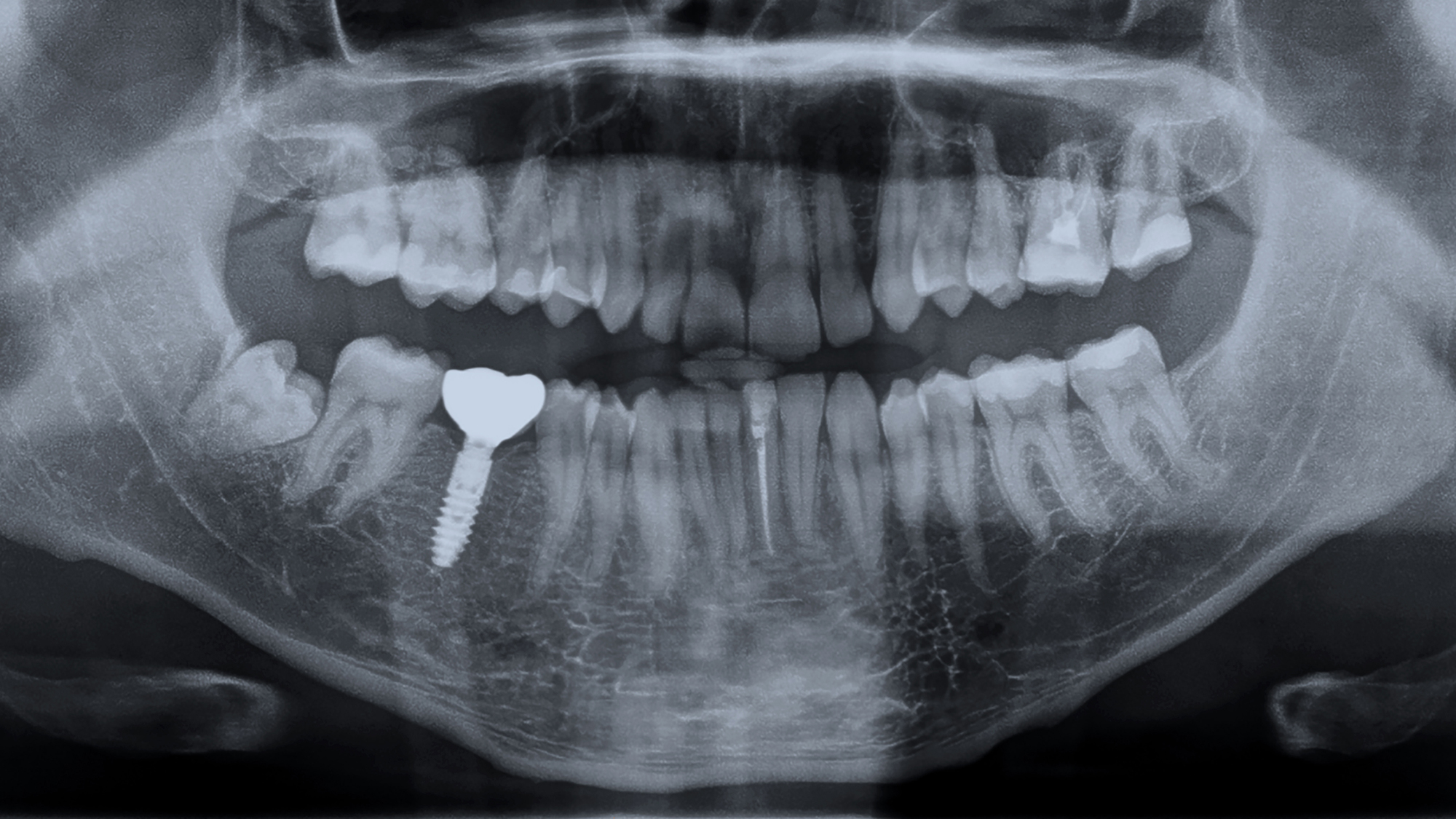 Implantaatverlies: 6 mm versus 10 mm implantaten