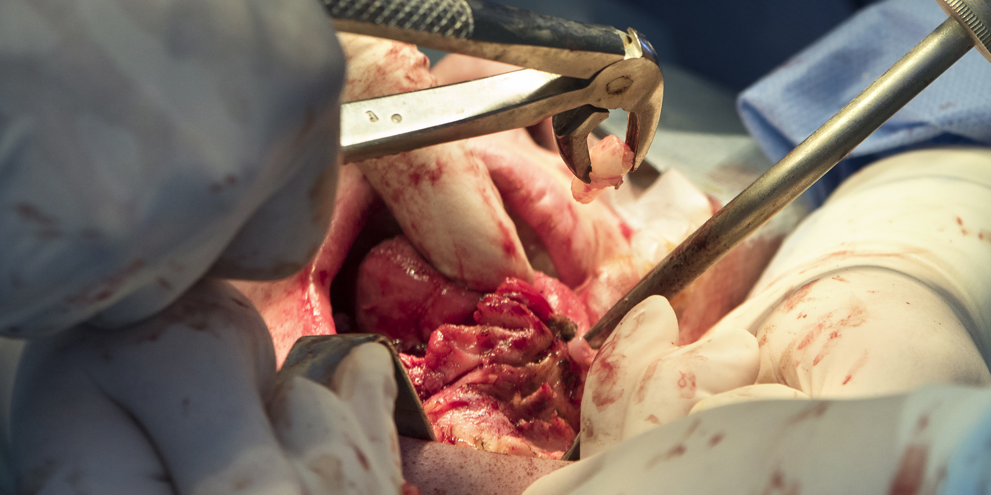 Orale leukoplakie bij behandelde patiënten met een plaveiselcelcarcinoom