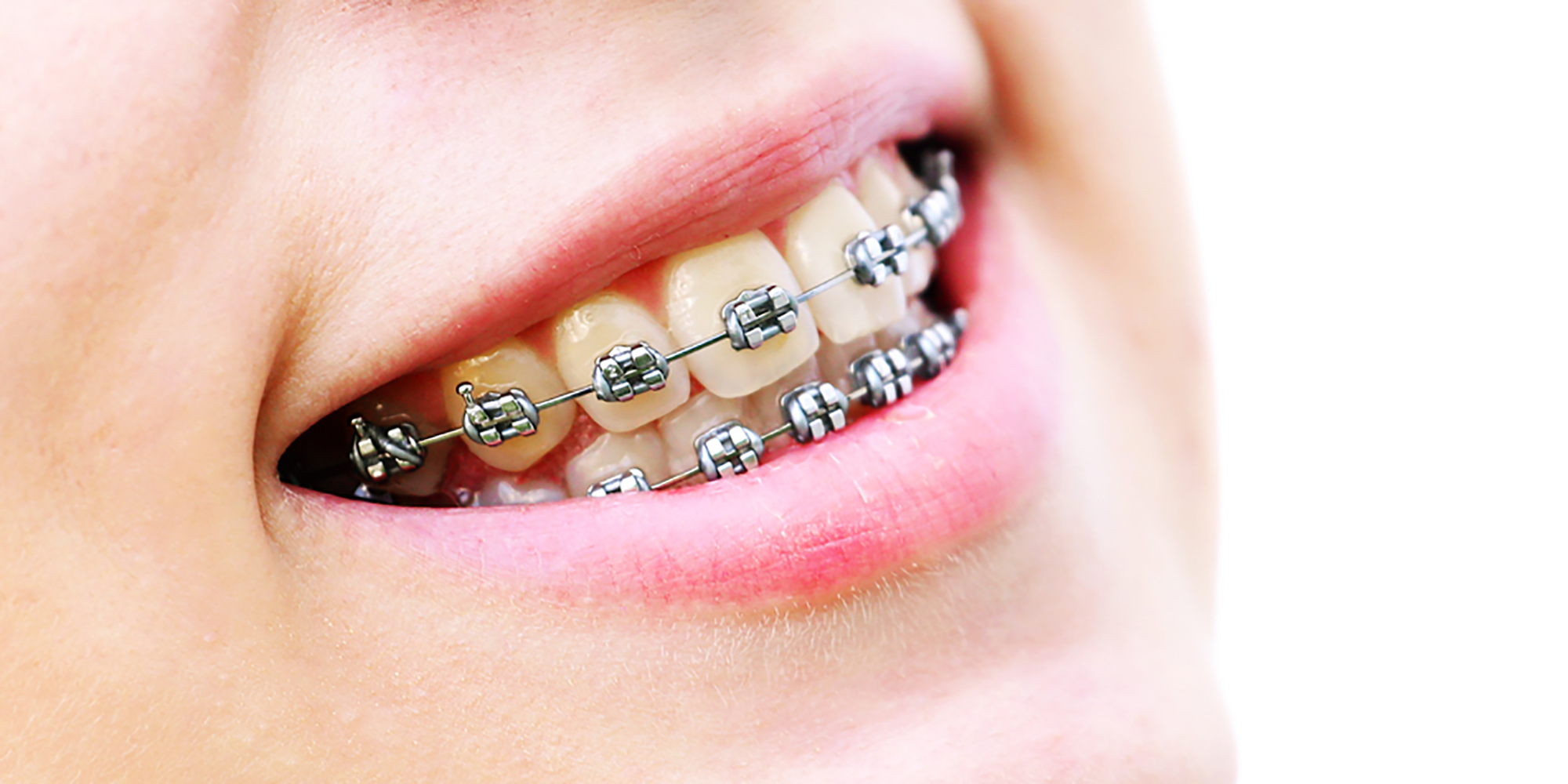De optimale kracht voor orthodontische tandverplaatsing
