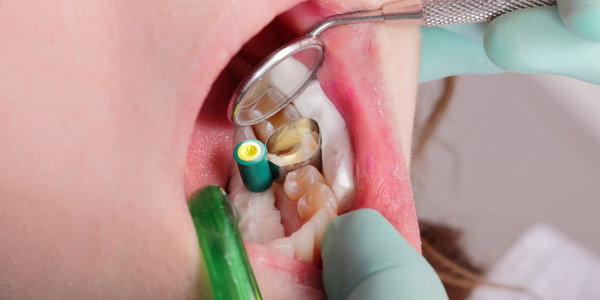 Hechten van glasionomeercement en adhesieven aan voorbehandeld dentine