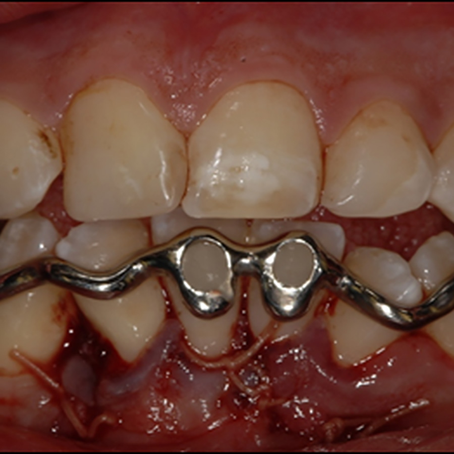 De driedimensionaal geprinte dentale spalk bij chirurgische behandeling van malocclusie na polytrauma