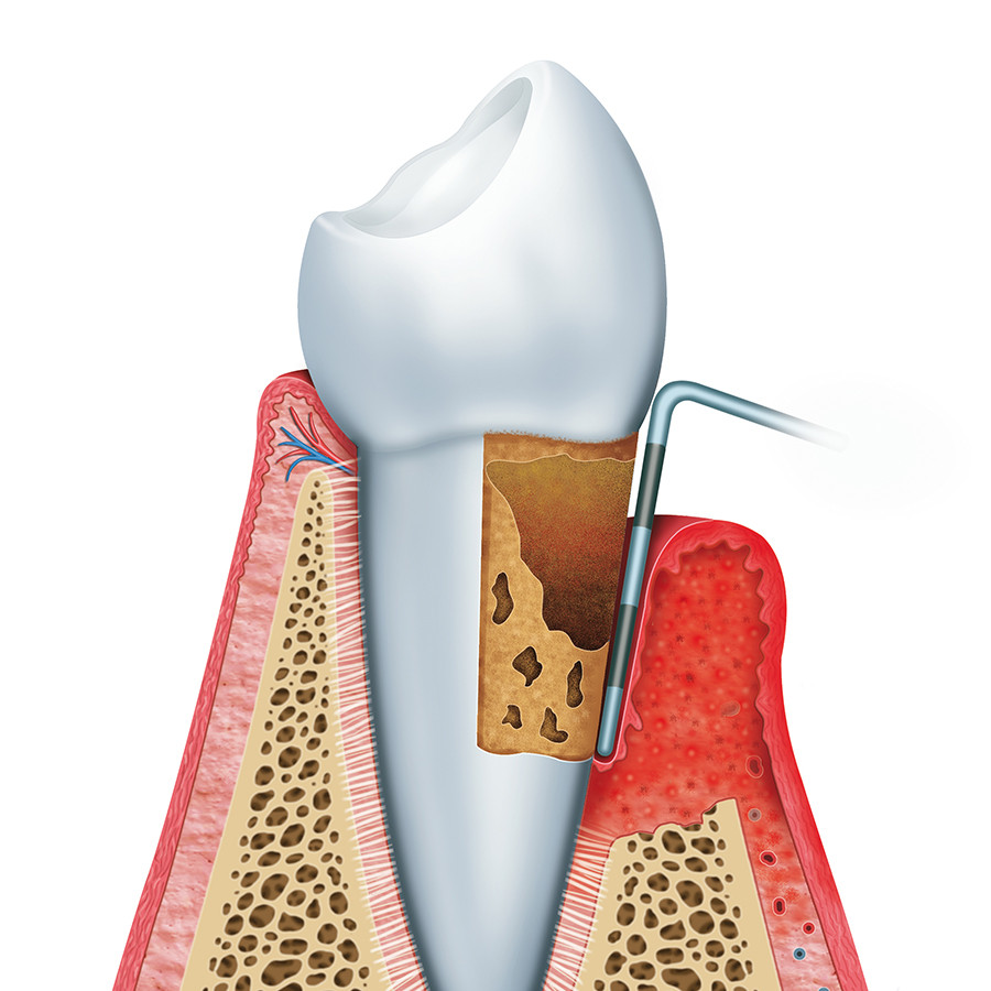 Parodontitis en systemische ziekten – van wetenschap naar praktijk