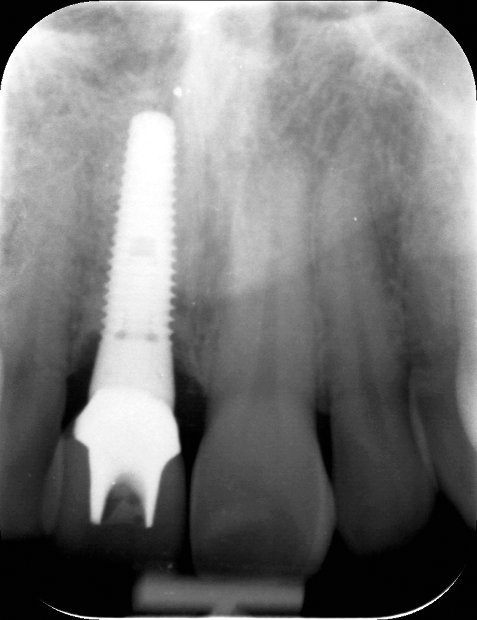 Orthodontische extrusie voorafgaand aan implantologie in de esthetische zone