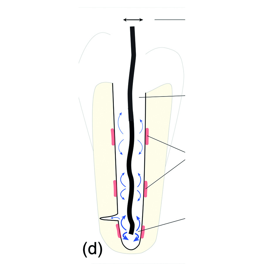 Endodontologie in beweging: nieuwe concepten, materialen en technieken 3. De rol van activatie van wortelkanaalspoelmiddelen tijdens de wortelkanaalbehandeling