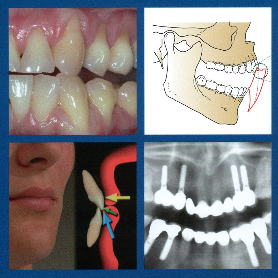 Occlusie en articulatie