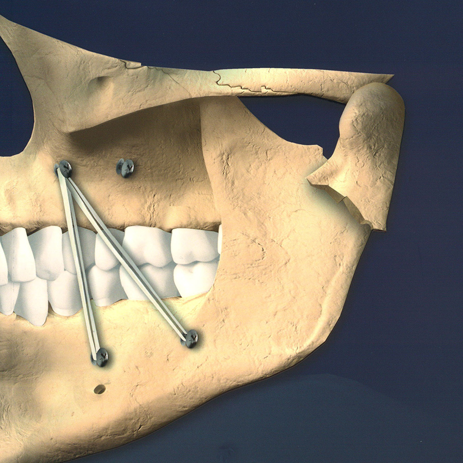 Behandeling van collum mandibulaefracturen