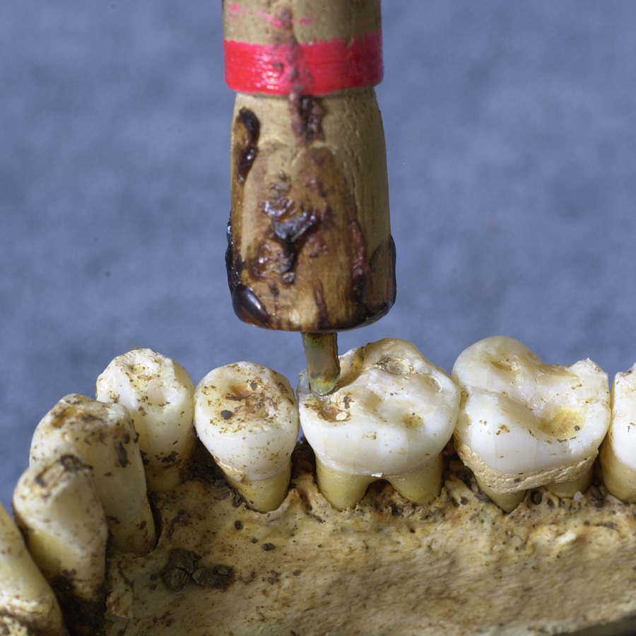 Tanden des tijds: onderzoek van gebitten en tanden uit archeologische opgravingen