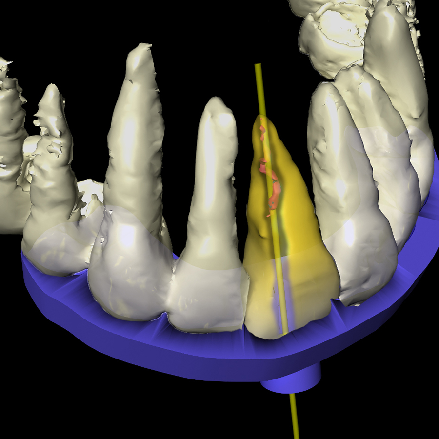 De synergie van radiologie en CAD/CAM