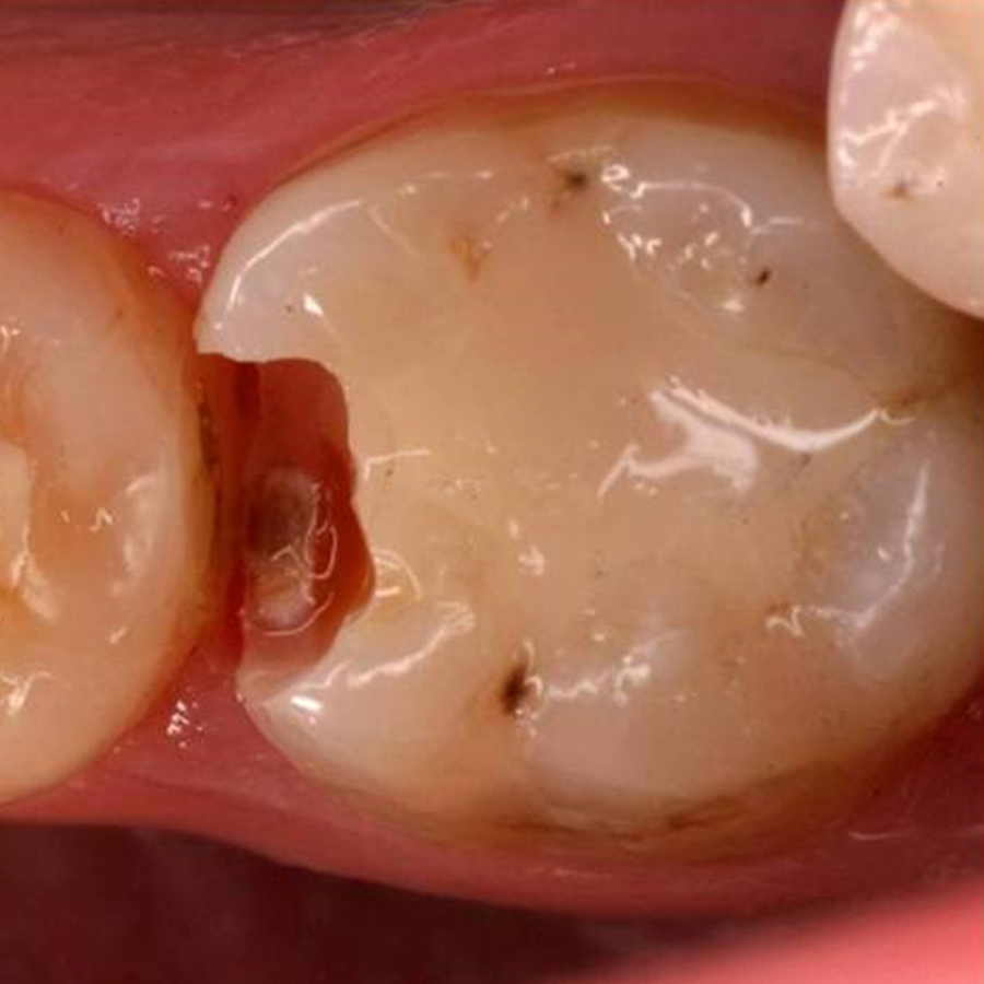 Preventieve tandheelkunde 5. Secundaire cariës