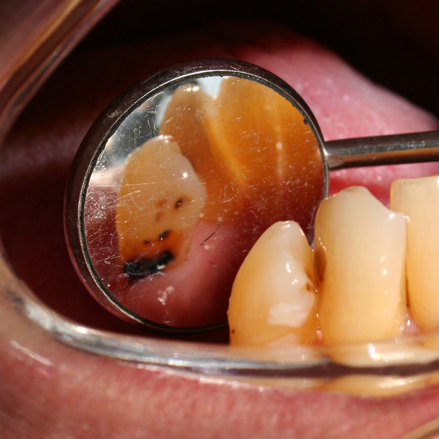 Preventieve tandheelkunde 6. Preventie van cariës bij kwetsbare ouderen
