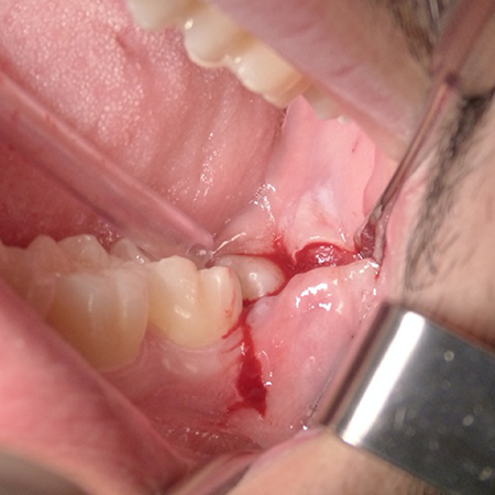 Incisietechnieken bij verwijdering van geïmpacteerde derde molaren in de onderkaak