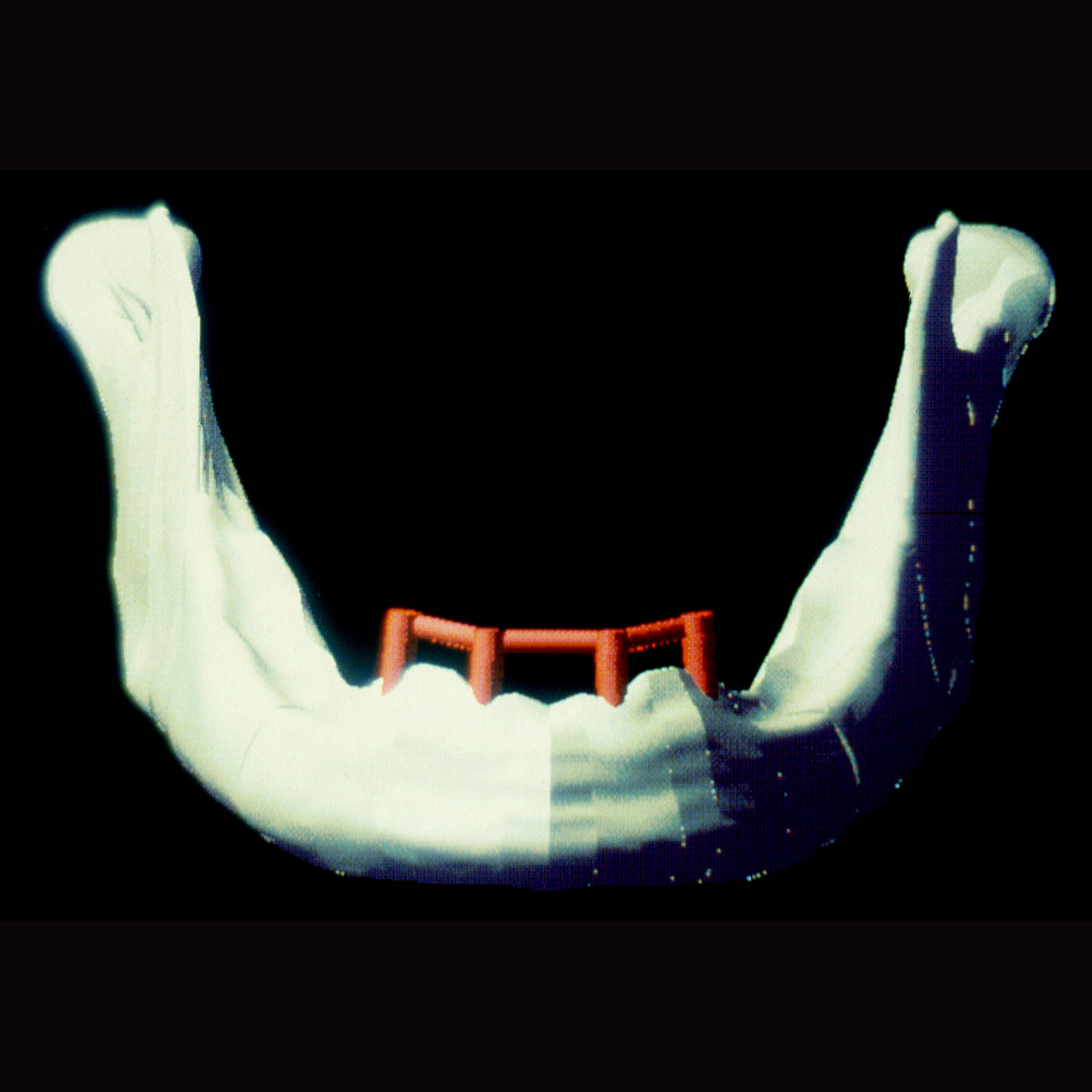 Proefschriften 25 jaar na dato 49. Biomechanische analyse van bot rond tandheelkundige implantaten in de edentate onderkaak