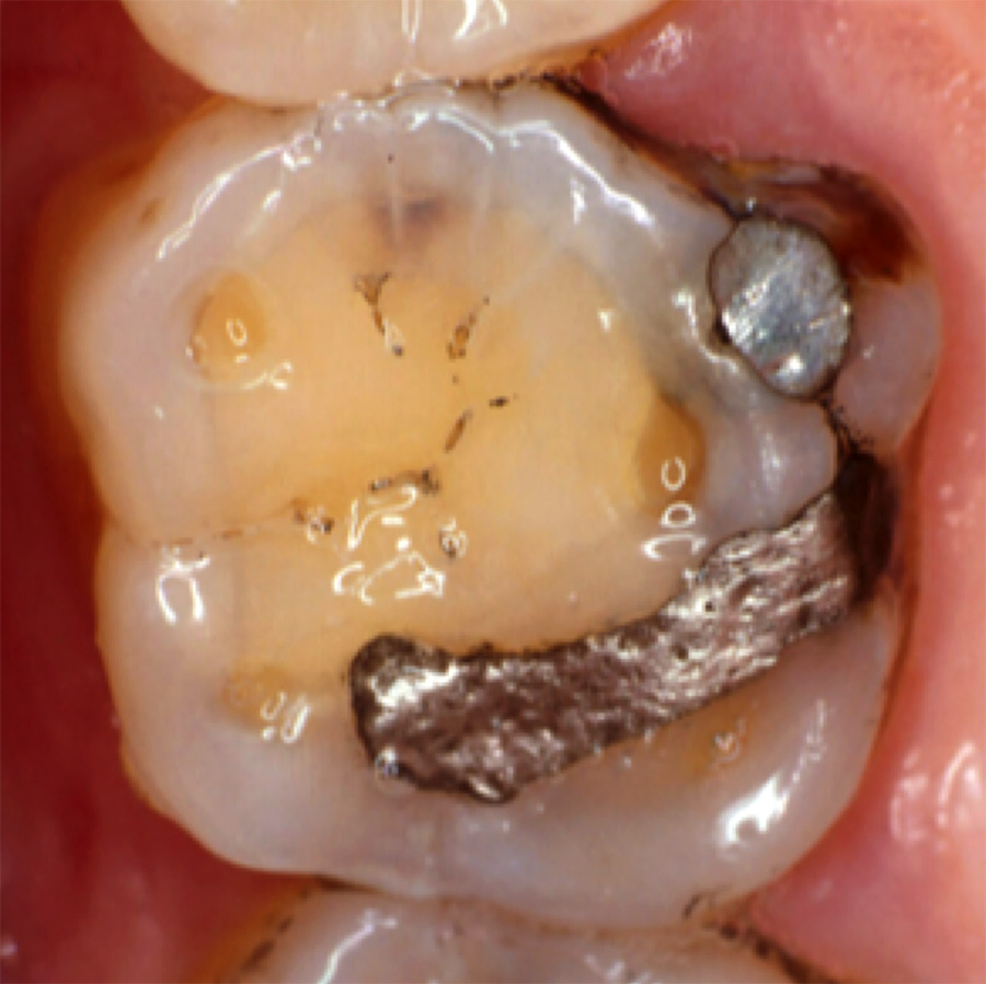 Preventieve tandheelkunde 10. Erosieve gebitsslijtage