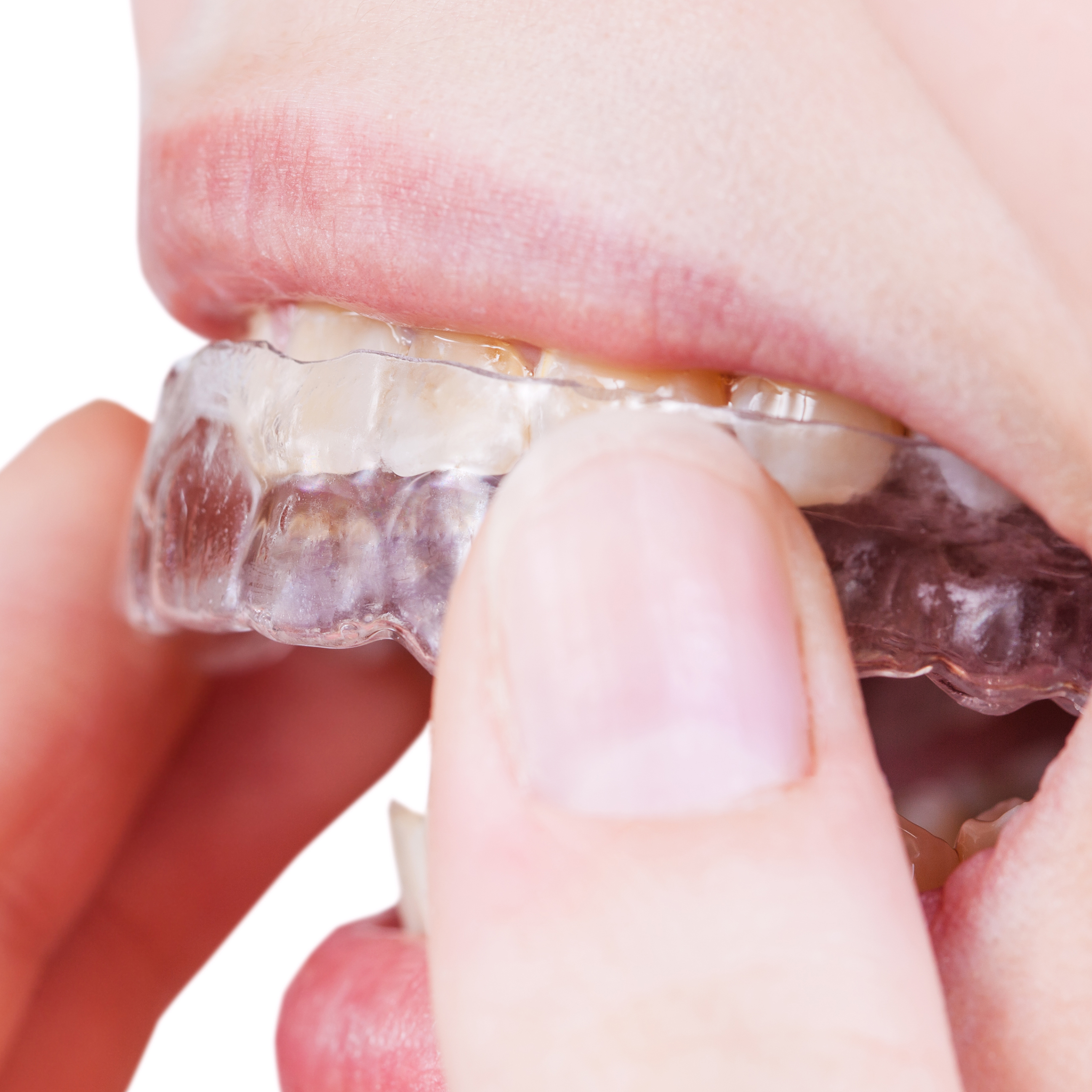 Mogelijkheden en beperkingen van orthodontische behandeling met clear aligners. Een verkenning