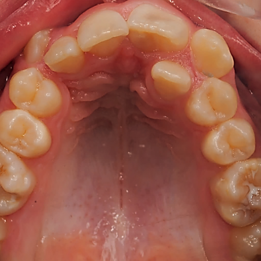 Orthodontische behandeling van een malocclusie met een gecompromitteerde centrale bovenincisief