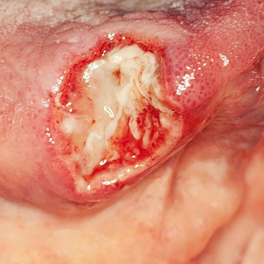 Arteriitis temporalis, orale verschijnselen zijn soms de eerste uiting