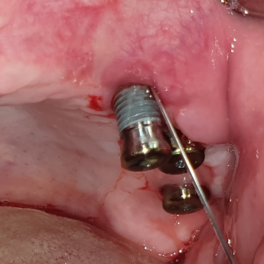 AB-profylaxe en (pre)implantologische chirurgie