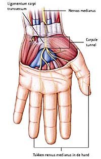 Diagnostiek en behandeling van het carpaletunnelsyndroom