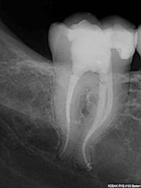 Risico-inventarisatie van endodontische behandelingen