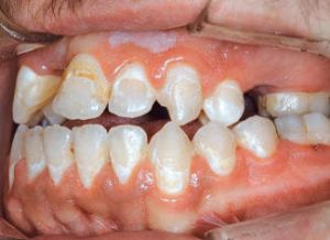 Wittevleklaesies tijdens orthodontische behandeling: preventief beleid