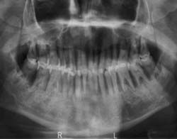Ernstige parodontitis als oorzaak voor onbegrepen koorts