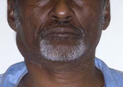 Een Afrikaanse man met een zwelling in de hals