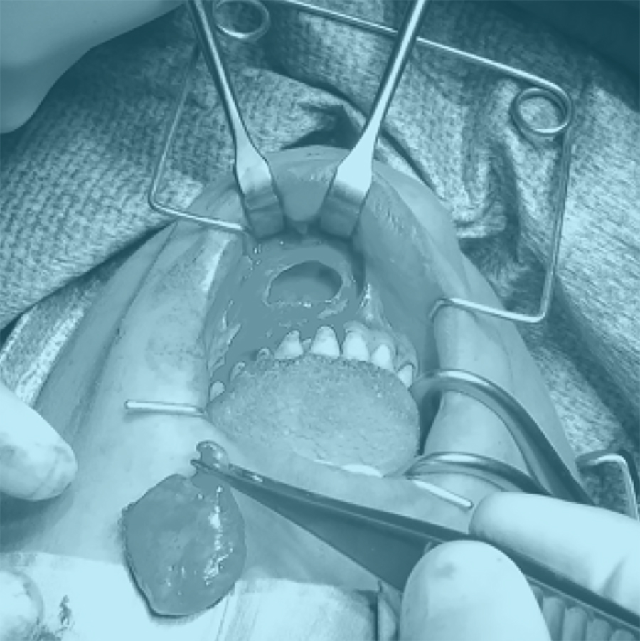 Botnecrose van de kaak zonder samenhang met medicijngebruik of radiotherapie
