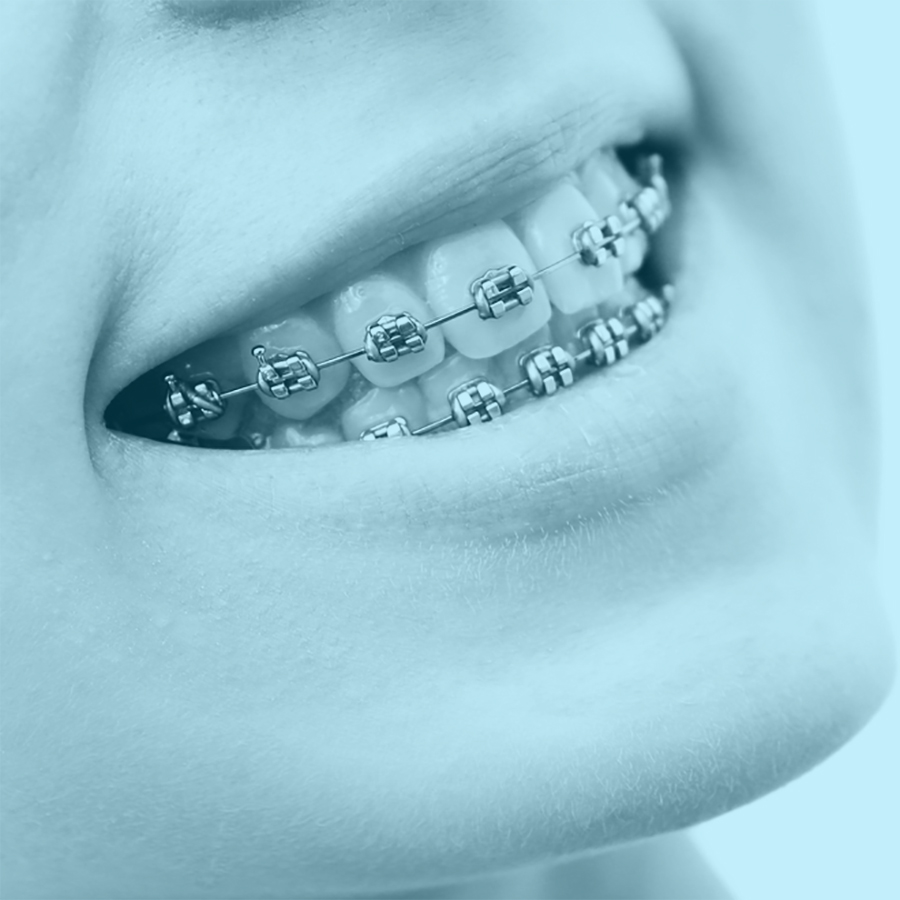 Versnellen chirurgische of niet-chirurgische ingrepen de orthodontische tandbeweging?